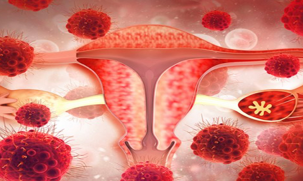 CBD・医療大麻と子宮内膜症